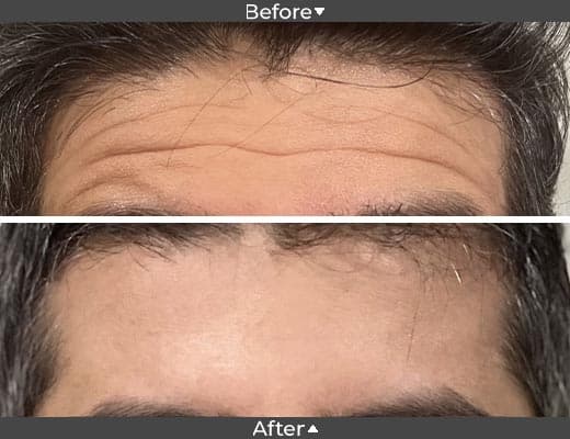 Forehead Toxin