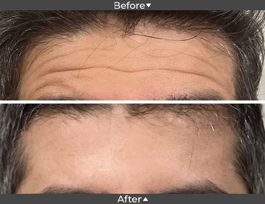 Forehead Toxin