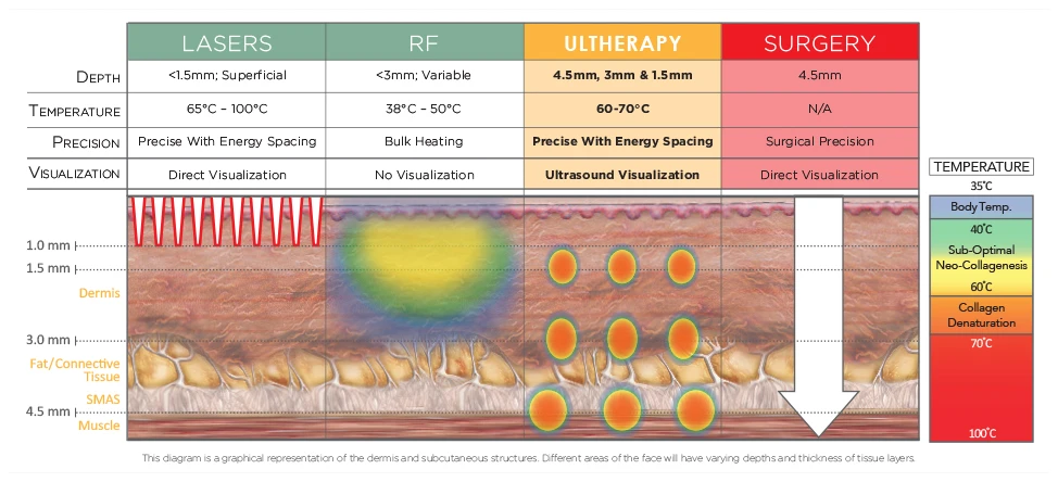 Comparison of lasers, radiofrequency, Ultherapy and surgery by treatment depth, temperature, precision and visualization. Ultherapy treats at 4.5, 3 and 1.5 mm with ultrasound visualization.