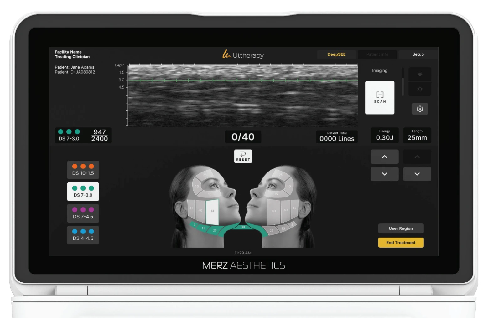 The Ultherapy PRIME screen showing a live ultrasound image of the skin layers with depth markers at 1.5, 3.0 and 4.5 mm
